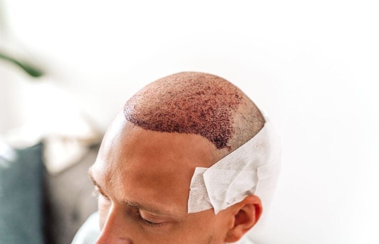 Patient after hair transplant operation