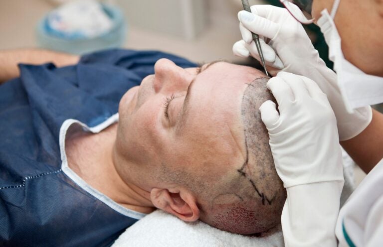 Hair restoration surgery