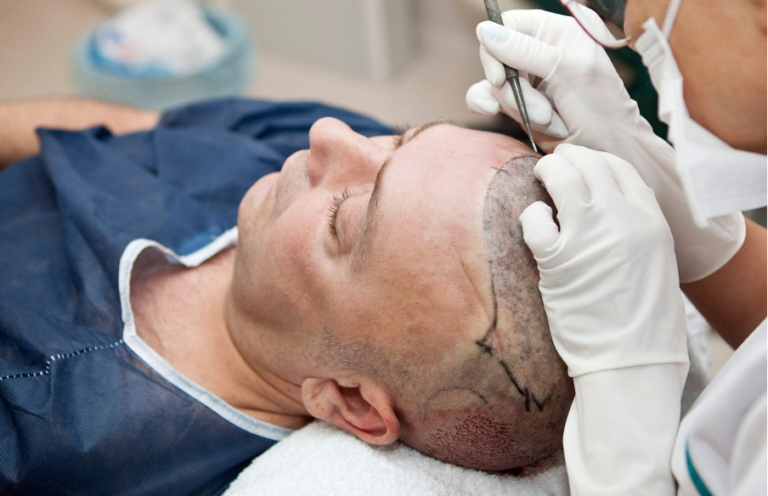 Nahaufnahme einer Haartransplantation